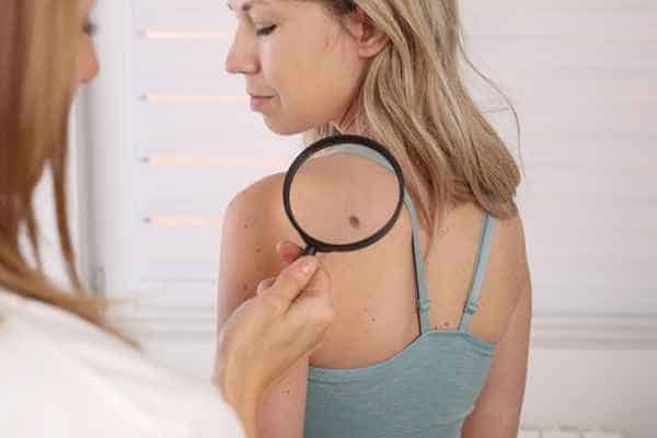What Are Traditional Skin Lesion Removal Methods Rutland?