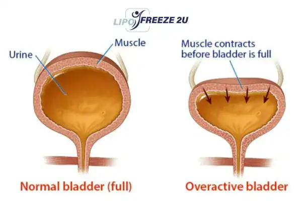diagram of overactive bladder treatment Rutland