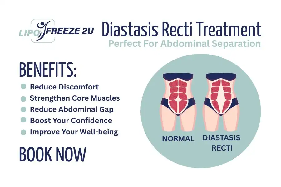 How Long Will It Take to See Improvements in Diastasis Recti Rutland