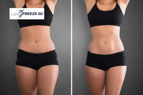 How Can LIPO FREEZE 2U Support Your Post-Pregnancy Body Recovery Rutland?