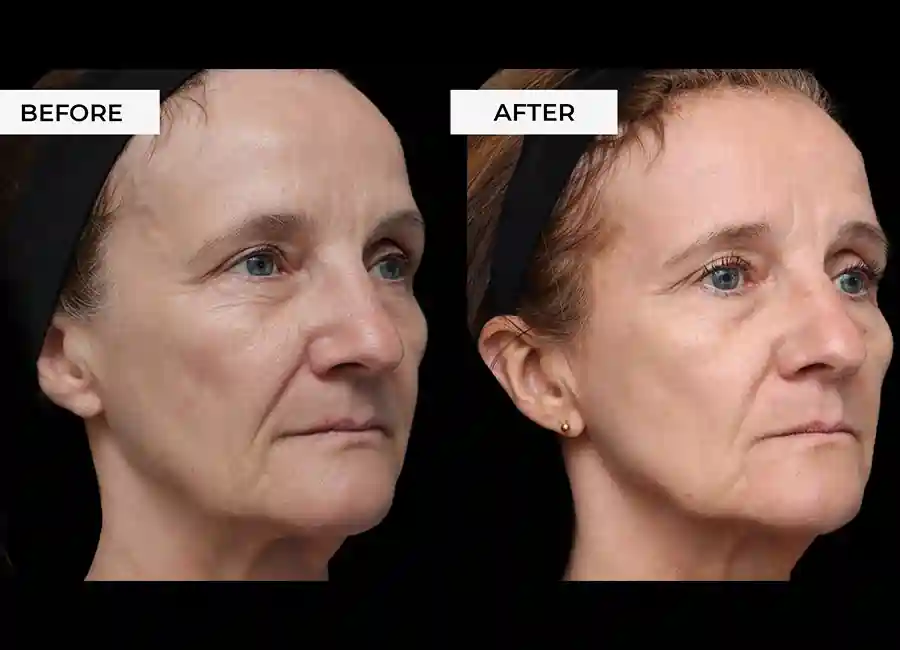 How Many RF Microneedling Sessions Will You Need to See a Difference Rutland?