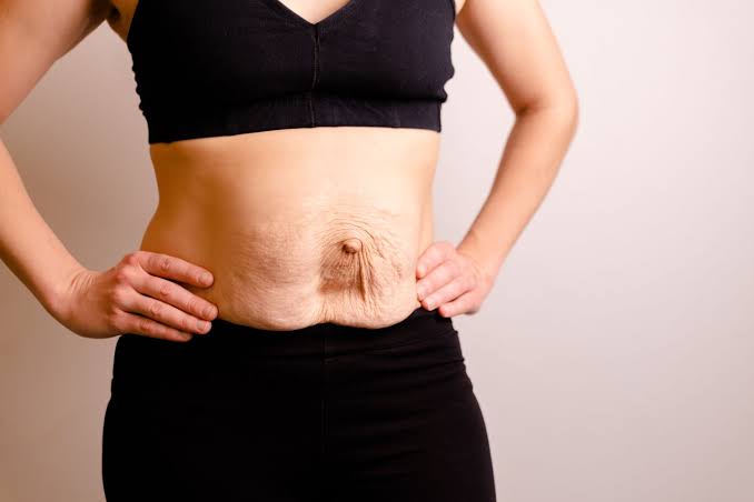 Is Surgery Really the Only Way to Repair Diastasis Recti Rutland?