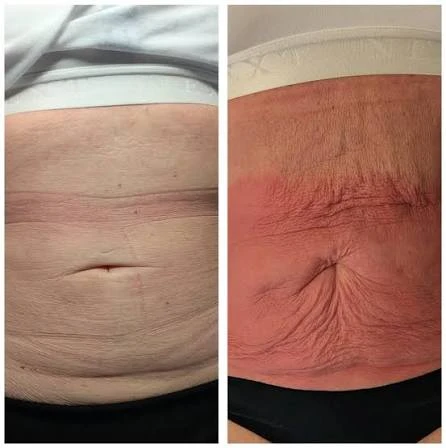 How Does RF Microneedling Improve Crepey, Thin and Uneven Skin Texture Rutland?