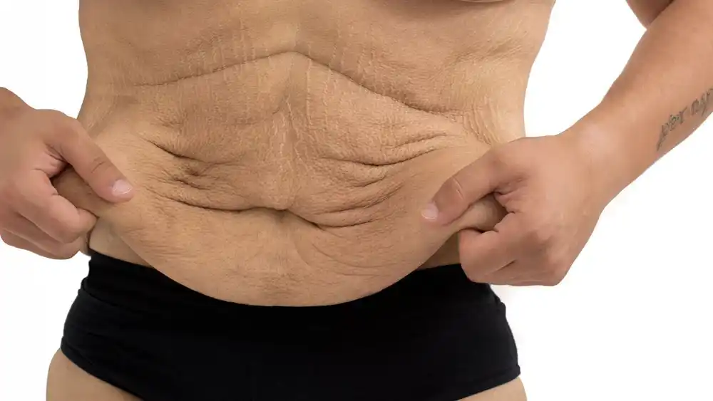 Why Does Weight Loss Medication Leave Some People With Loose or Sagging Skin Rutland?